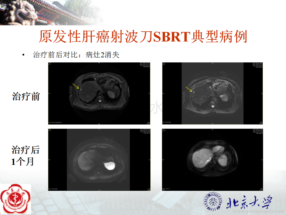 原发性肝癌典型病例3个病灶_04.png