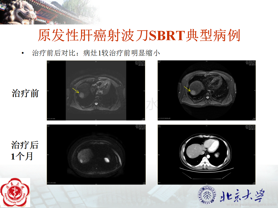 原发性肝癌典型病例3个病灶_03.png